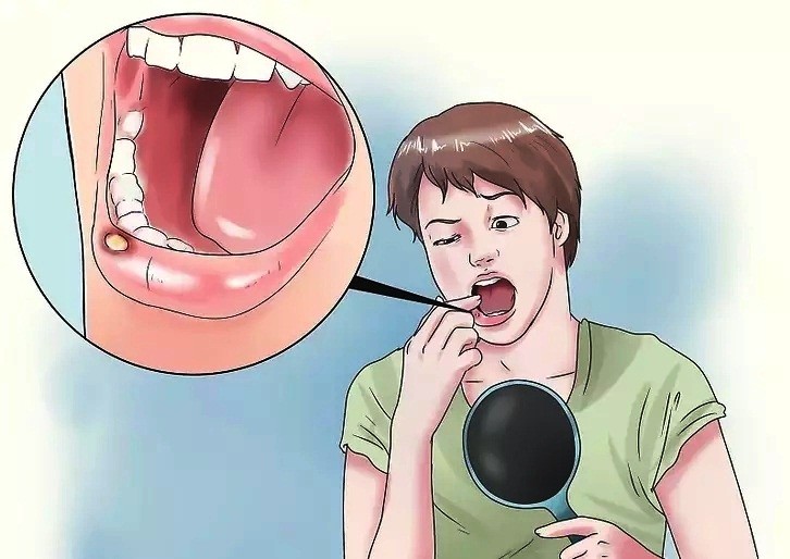 7 Cách chữa nhiệt miệng nhanh nhất tại nhà bạn cần biết