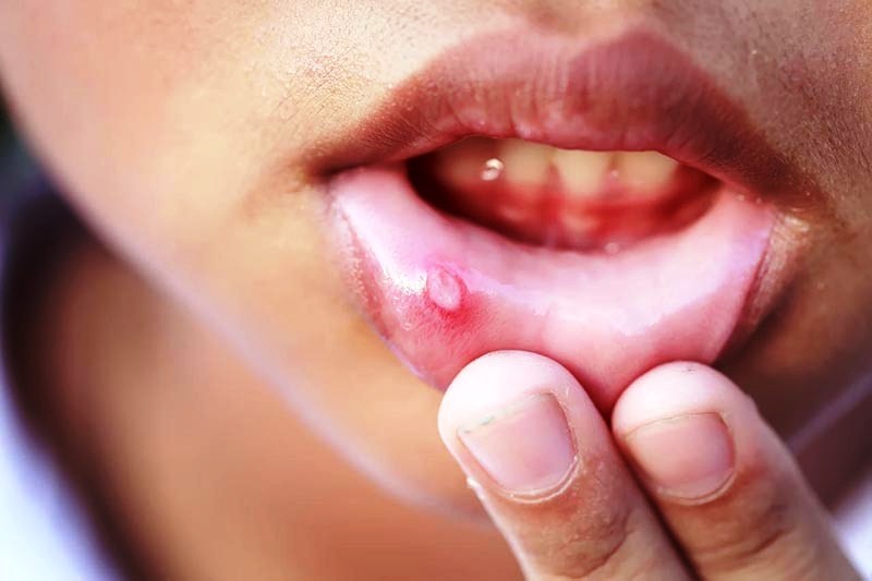 7 Cách chữa nhiệt miệng nhanh nhất tại nhà bạn cần biết