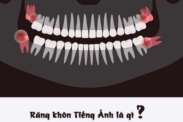 Răng khôn tiếng anh là gì? Mọc răng khôn Tiếng Anh nói thế nào?
