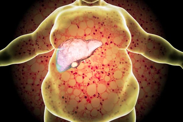Bệnh gan nhiễm mỡ là gì? Đối tượng nào dễ mắc bệnh gan bị nhiễm mỡ?