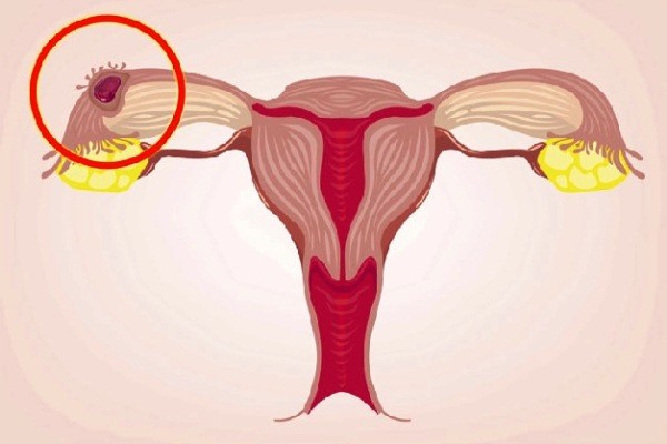 Mang thai ngoài tử cung là gì? Mang thai ngoài tử cung thử có lên 2 vạch không?