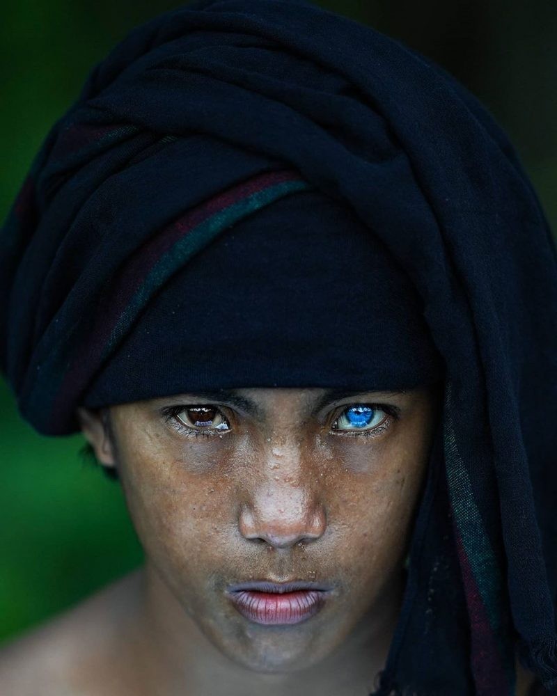 Bộ lạc sở hữu đôi mắt màu xanh đặc biệt do mắc hội chứng hiếm gặp