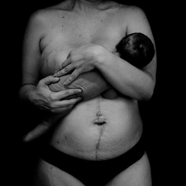 Chùm ảnh chân thật về những vết rạn sau sinh khiến ai nhìn vào cũng phải xót xa vì sự tàn phá kinh khủng đối với cơ thể phụ nữ