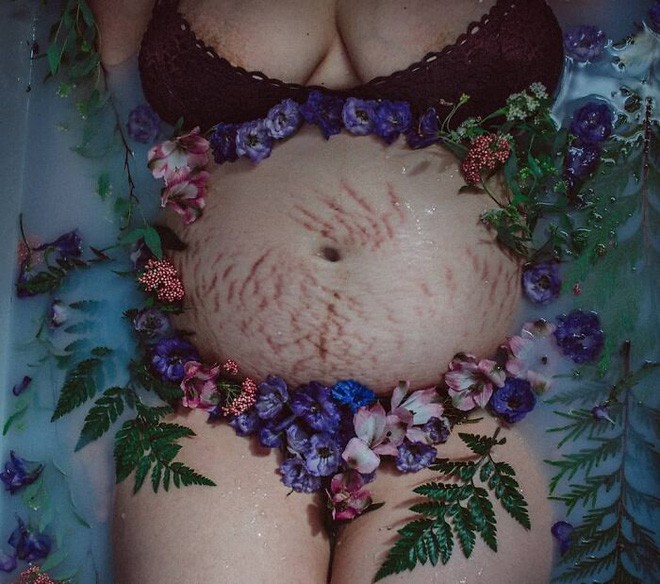 Chùm ảnh chân thật về những vết rạn sau sinh khiến ai nhìn vào cũng phải xót xa vì sự tàn phá kinh khủng đối với cơ thể phụ nữ