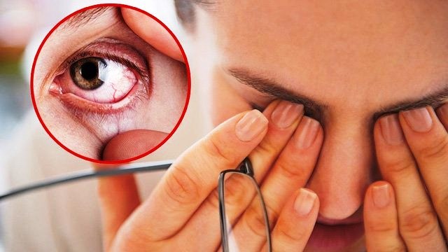 Mắt kém tức gan có vấn đề đã đến lúc cần dưỡng gan
