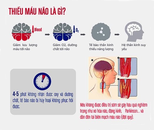 Thiếu máu não là gì? Thiếu máu não có nguy hiểm không?