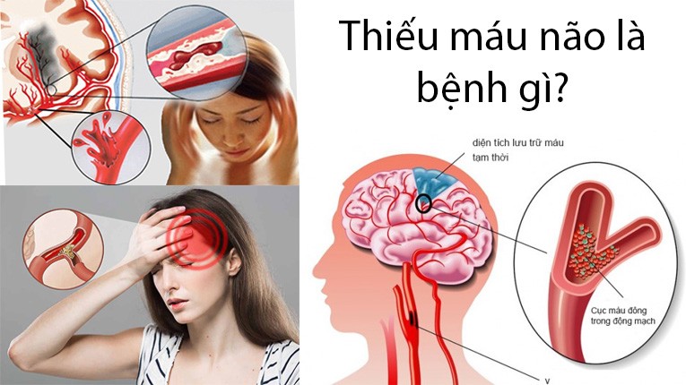 Thiếu máu não là gì? Thiếu máu não có nguy hiểm không?