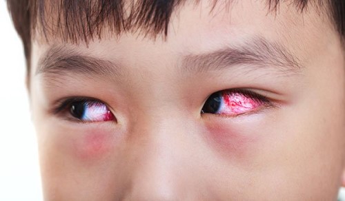 Nguyên nhân đau mắt đỏ ở trẻ em và khi nào cần đưa trẻ đến gặp bác sĩ?
