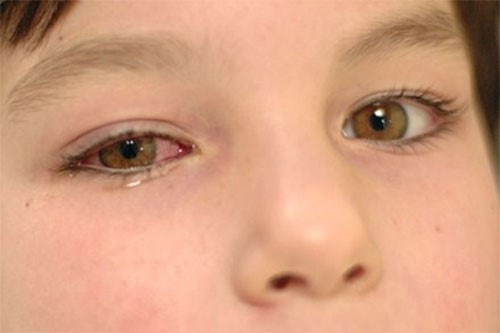 Nguyên nhân đau mắt đỏ ở trẻ em và khi nào cần đưa trẻ đến gặp bác sĩ?