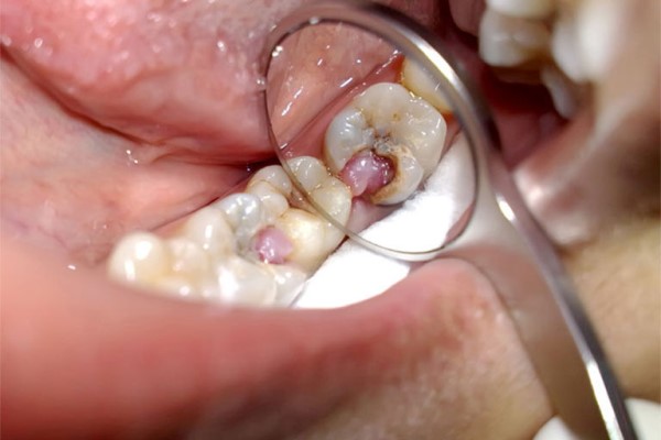 Bài thuốc dân gian điều trị sâu răng tại nhà hiệu quả