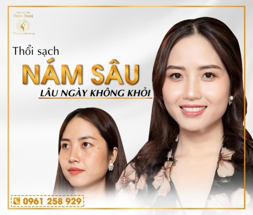 Top thẩm mỹ Spa trị nám hiệu quả nhất ở Hà Nội các tín đồ làm đẹp đã biết chưa?