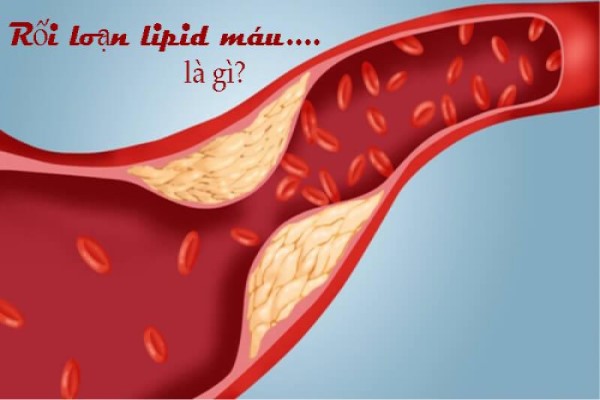Định Nghĩa Rối Loạn Lipid Máu là gì? Nguyên nhân triệu chứng Rối Loạn Lipid Máu