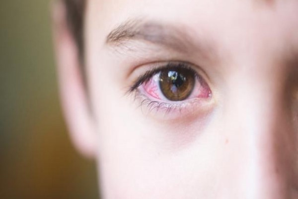 Đau mắt đỏ - Thực phẩm nên kiêng khi đau mắt đỏ và lưu ý những gì
