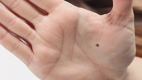 Có phải nốt ruồi ở tay ăn vay cả đời? Tay bạn có nốt ruồi không